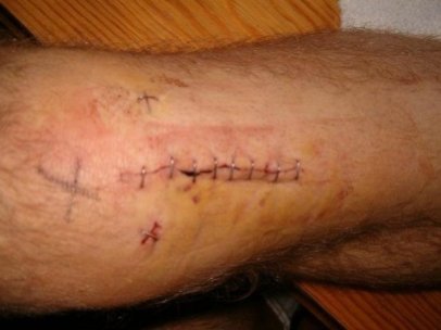 Knee surgery in the end of 2009.